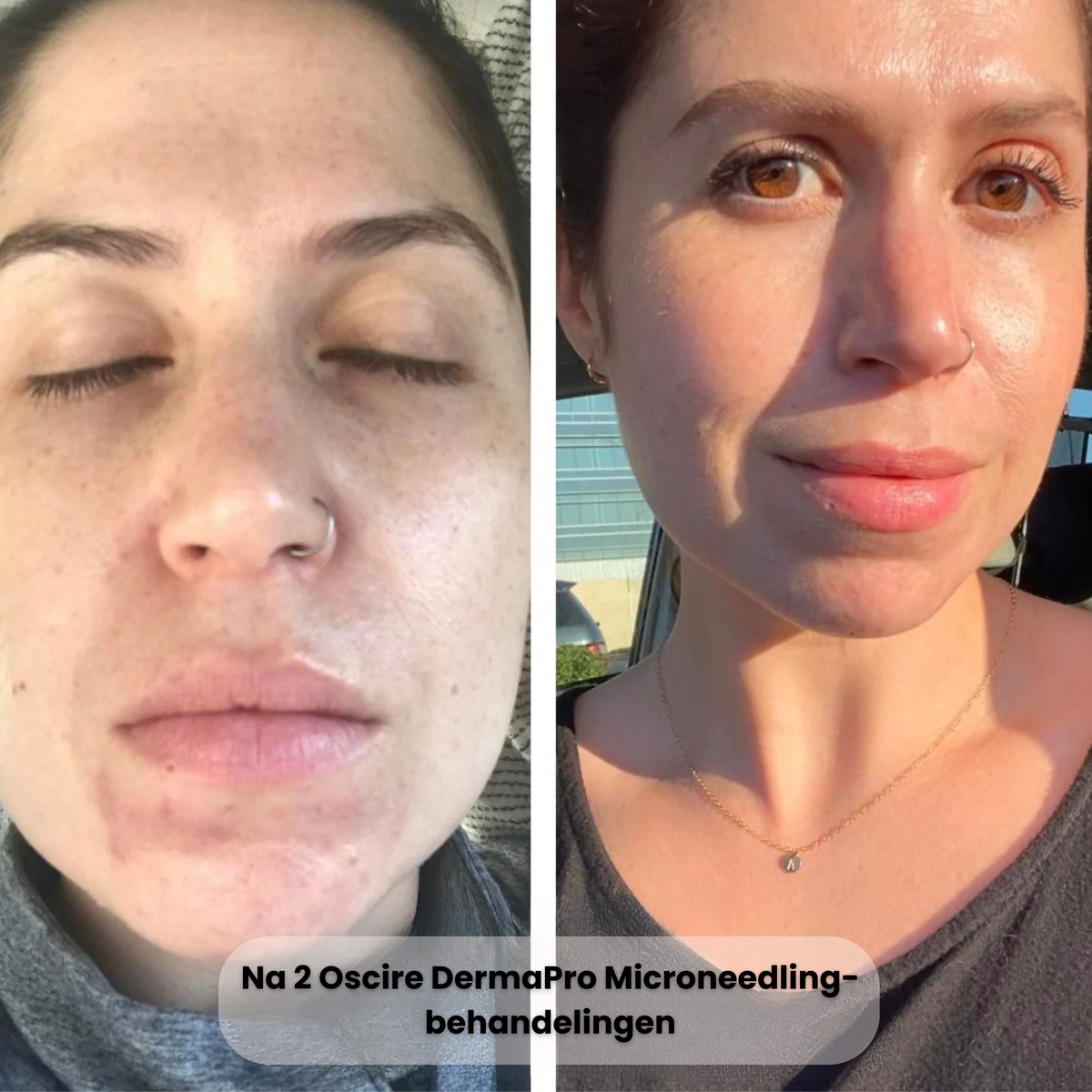DermaPro Microneedling-pen – Professionele Precisie-Huidverjonging voor Thuis