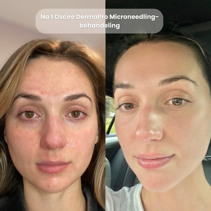 DermaPro Microneedling-pen – Professionele Precisie-Huidverjonging voor Thuis