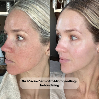 DermaPro Microneedling-pen – Professionele Precisie-Huidverjonging voor Thuis