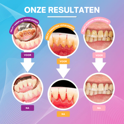 BrightEase | Ultrasone Tandereiniger