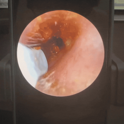Aurilens Oorcamera – Veilige, Herbruikbare Oorreiniger met HD Beeld op je Smartphone