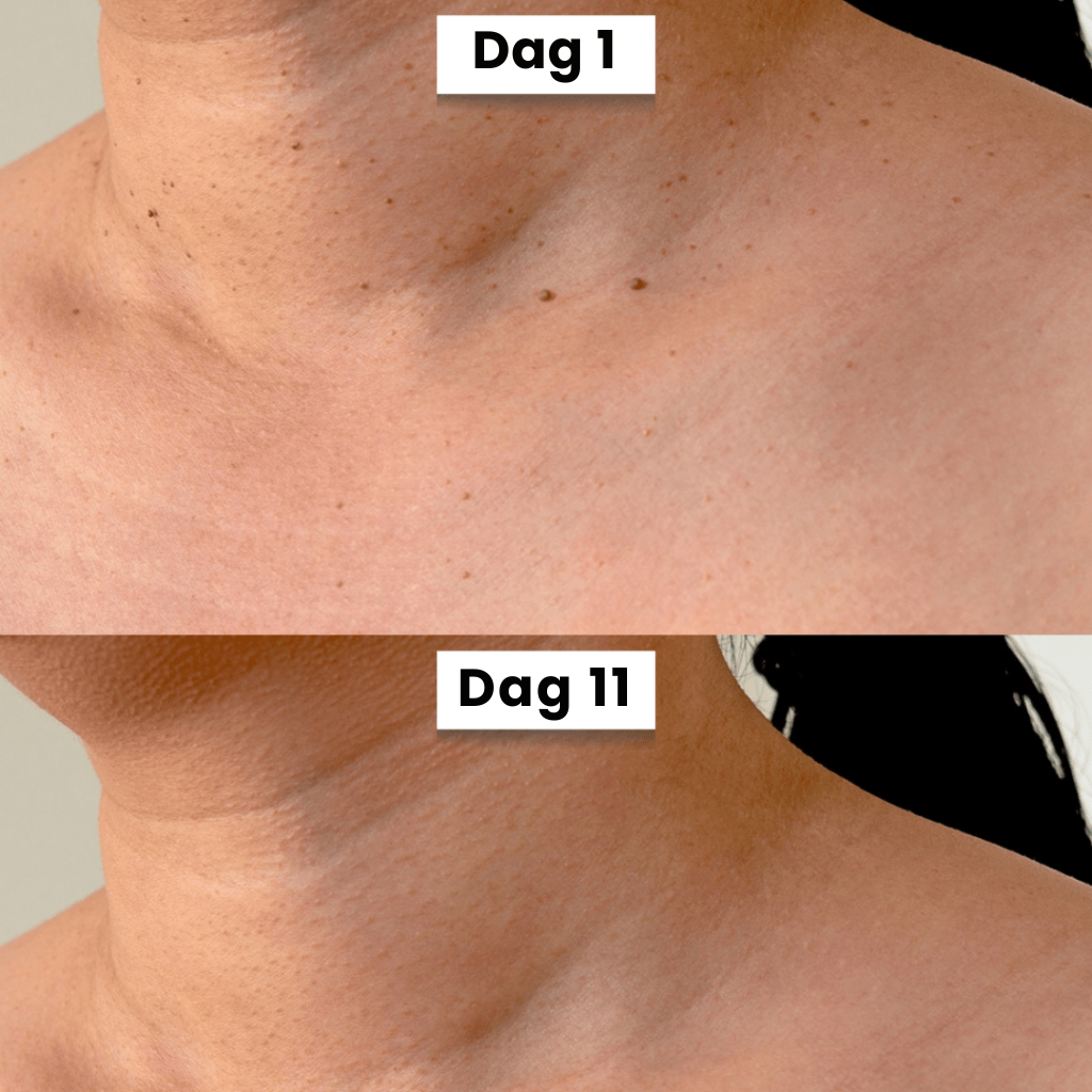 DermaSeal Thuisbehandelkit – Voor het Veilig Verwijderen van Huidflapjes