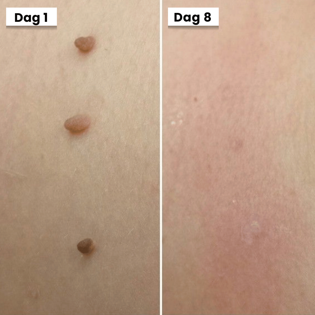 DermaSeal Thuisbehandelkit – Voor het Veilig Verwijderen van Huidflapjes