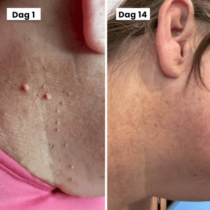 DermaSeal Thuisbehandelkit – Voor het Veilig Verwijderen van Huidflapjes