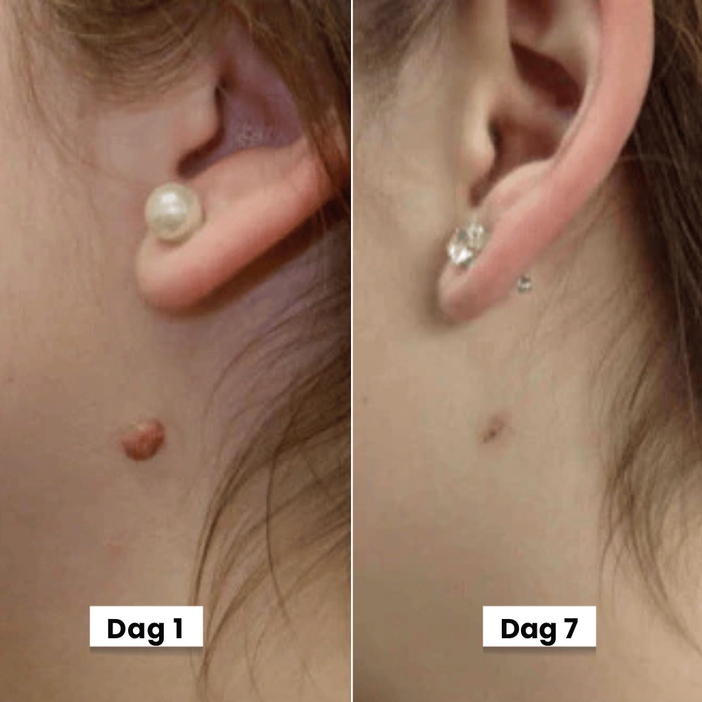 DermaSeal Thuisbehandelkit – Voor het Veilig Verwijderen van Huidflapjes