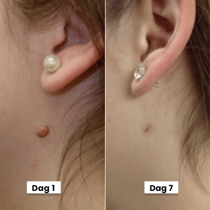 DermaSeal Thuisbehandelkit – Voor het Veilig Verwijderen van Huidflapjes