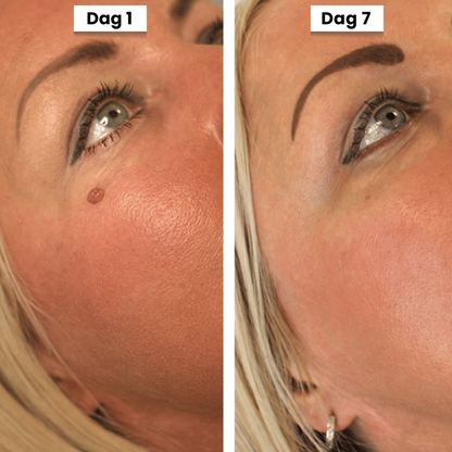 DermaSeal Thuisbehandelkit – Voor het Veilig Verwijderen van Huidflapjes